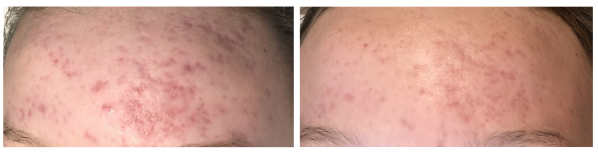 Acne Before After Results
